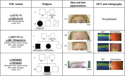 Non-syndromic Oculocutaneous Albinism: Novel Genetic Variants and Clinical Follow Up of a Brazilian Pediatric Cohort